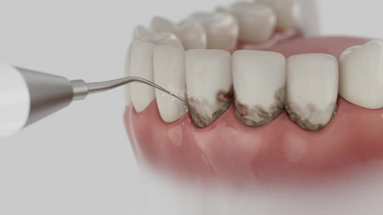 Trusted Wisdom Tooth Removal service in Trinity, AL - Dentist Open Now
